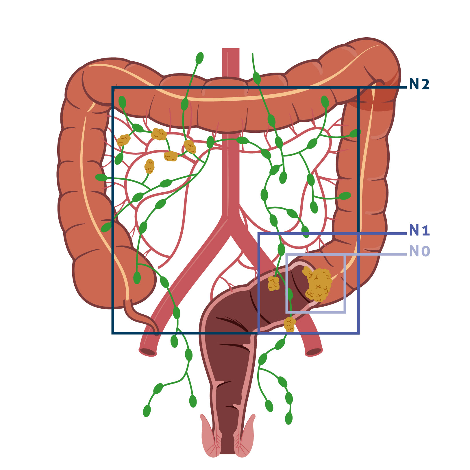 Vivio :: Atlas médical cancer colorectal
