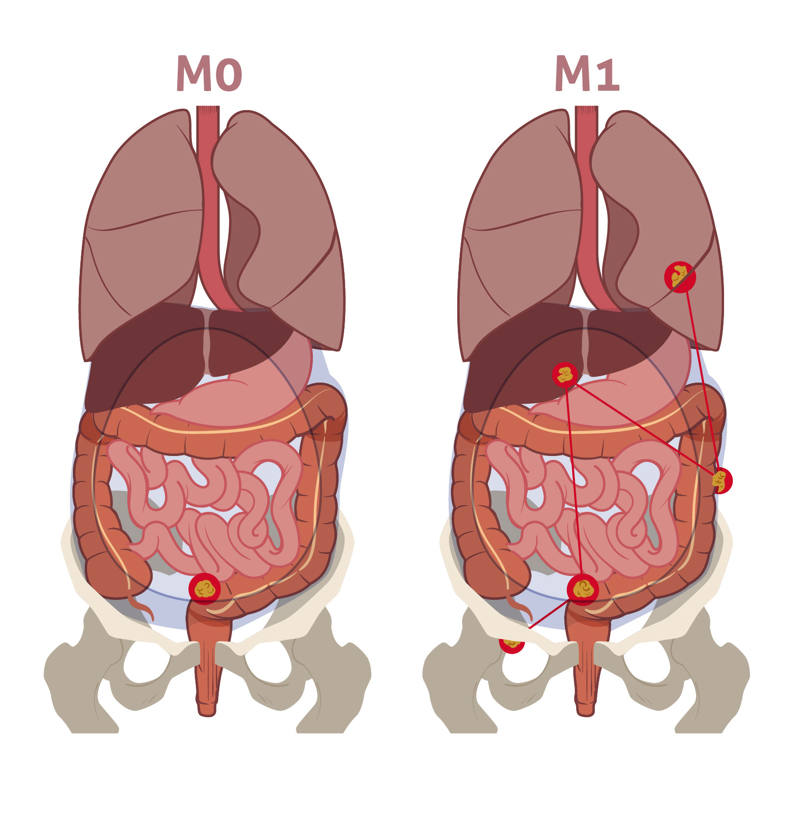 Vivio :: Atlas médical cancer colorectal