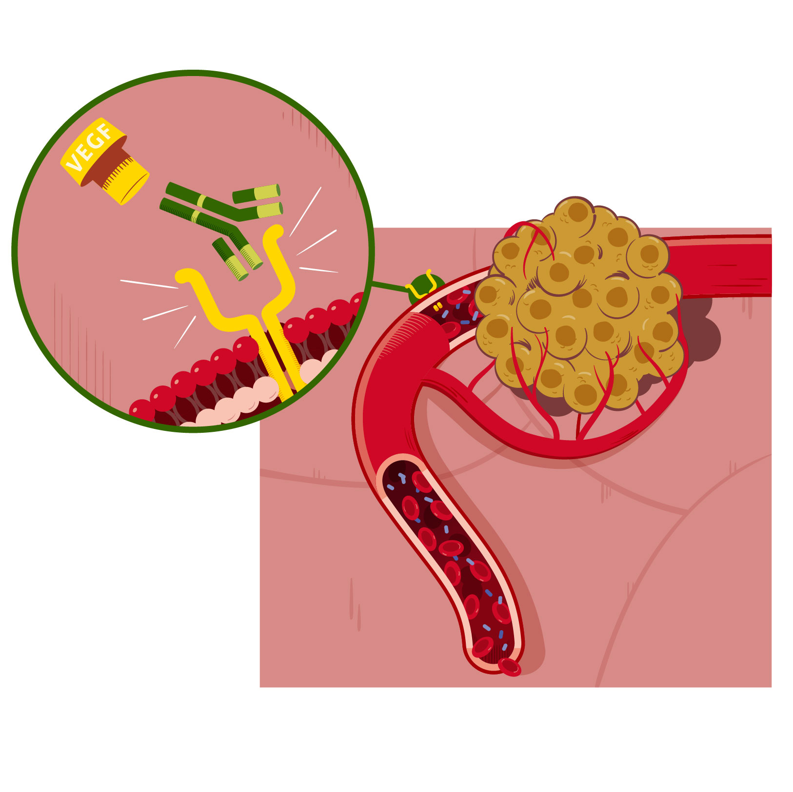 Vivio :: Atlas médical cancer colorectal