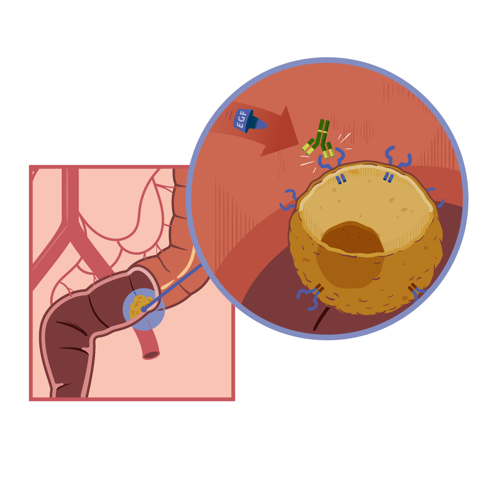 Vivio :: Atlas médical cancer colorectal