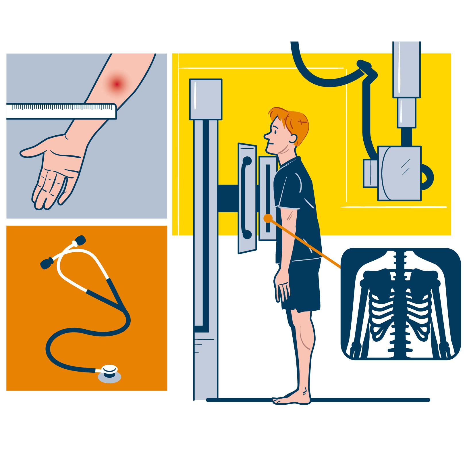 Rhumatisme psoriasique