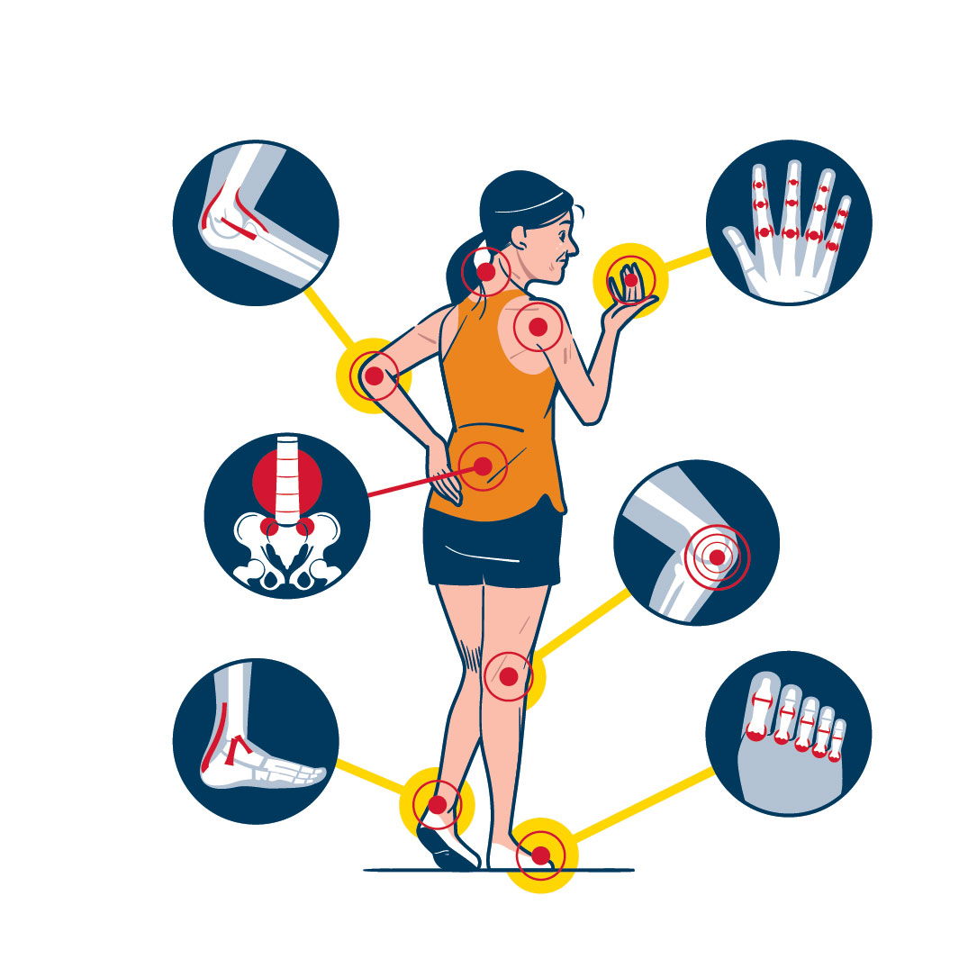 Rhumatisme psoriasique
