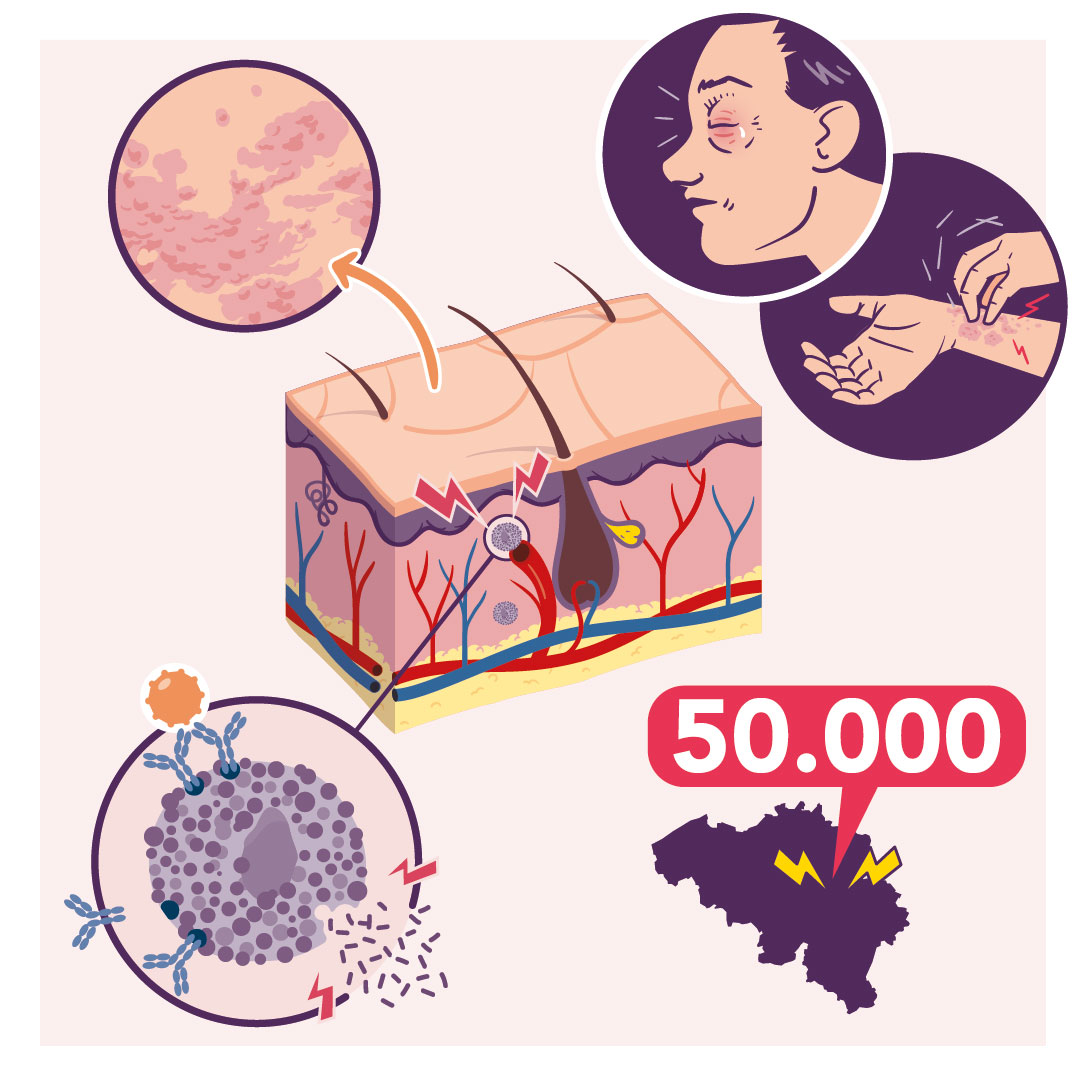 Plaquette info :: Urticaire en Belgique