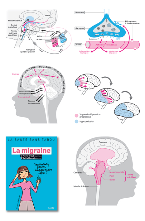 Schémas réalisés pour un livre sur la migraine (Mango, 2019).