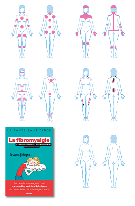 Schémas réalisés pour un livre sur la fibromyalgie (Mango, 2020).